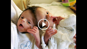 Шанс этих сросшихся близнецов на жизнь был меньше 7 %. Однако итог операции поразил врачей…