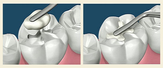 dental-composite-filling-illustration