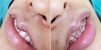 уменьшение губ